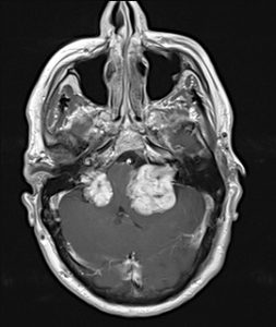 Facomatosis