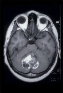 Meduloblastomas