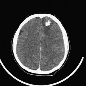 Oligodendrogliomas