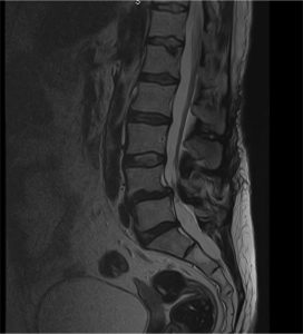 Patología de columna-estenosis de canal lumbar