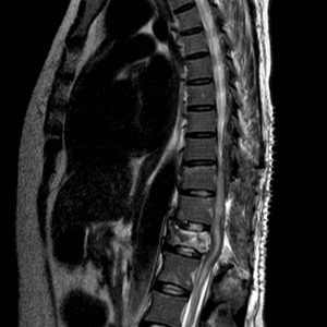 Patología lumbar: estenosis del canal torácico