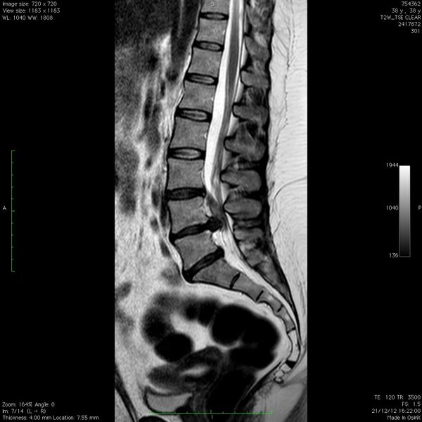 Hernia Discal Lumbar