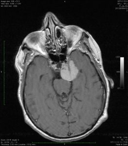 Meningioma