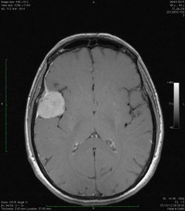 meningioma convexidad