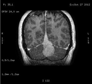 meningioma-falcotentorial coronal seno invadido