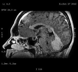 meningioma falcotentorial sagital