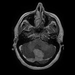 meningioma falcotentorial