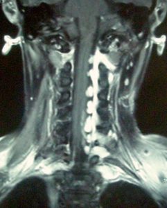 neurofibromatosis