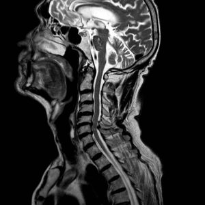 Dolores cervicales. patologia columna cervical