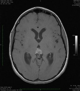 tumor pineal axial