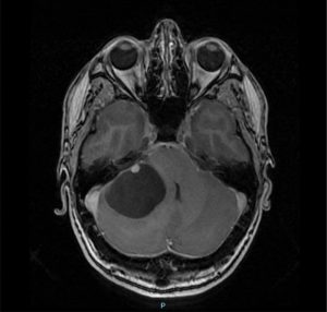 tumores-cerebrales-hemangioblastoma