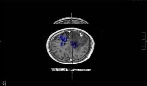 Mapping Cerebral