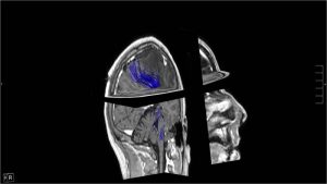 Mapping cerebral DTI-1