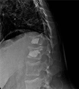 técnicas neurocirugia: cifoplastias