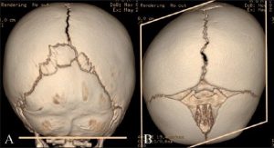 Plagiocefalia postural